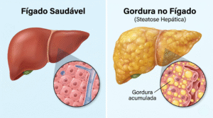 Gordura no Fígado: Como reverter a Gordura no Fígado: Dieta, Exercícios e Novos Diagnósticos